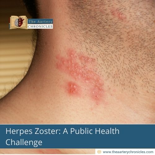Herpes-Zoster:-A-Public-Health-Challenge-The-Aartery-Chronicles-TAC