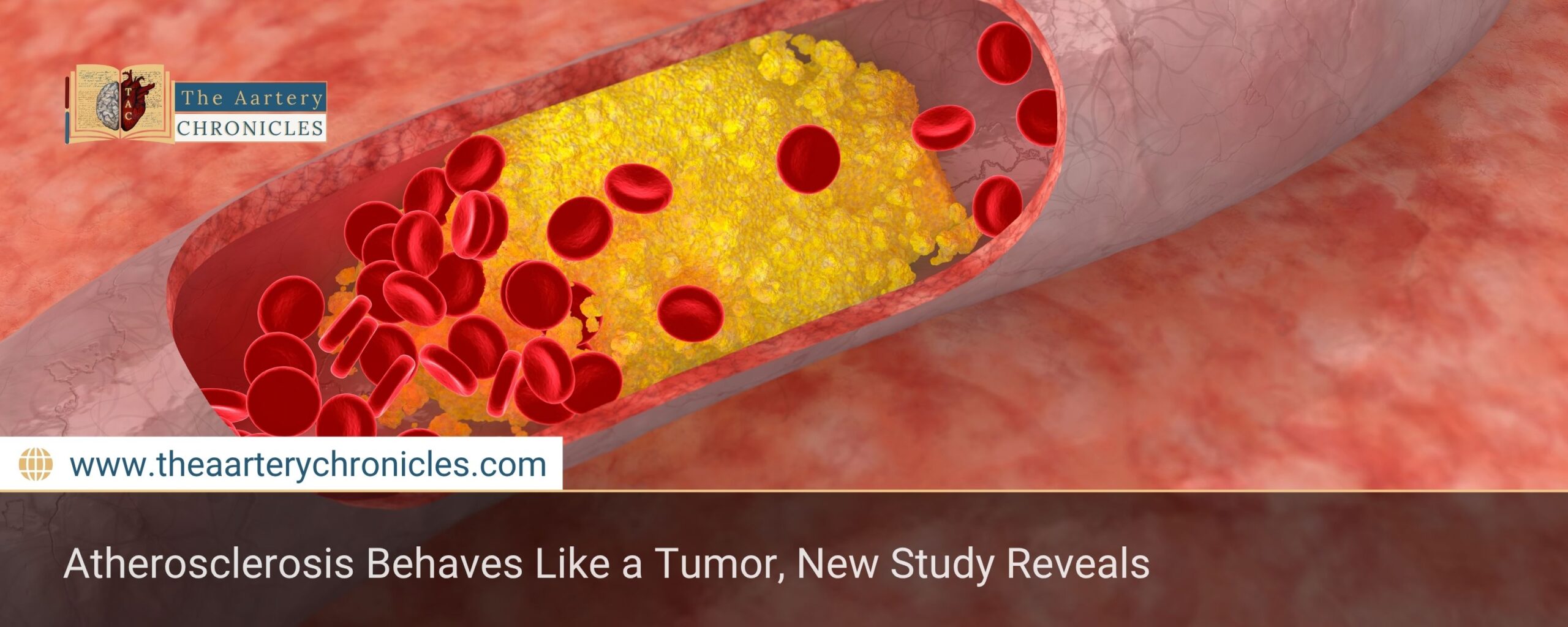 atherosclerosis-behaves-like-a-tumor-new-study-reveals-the-aartery-chronicles-tac