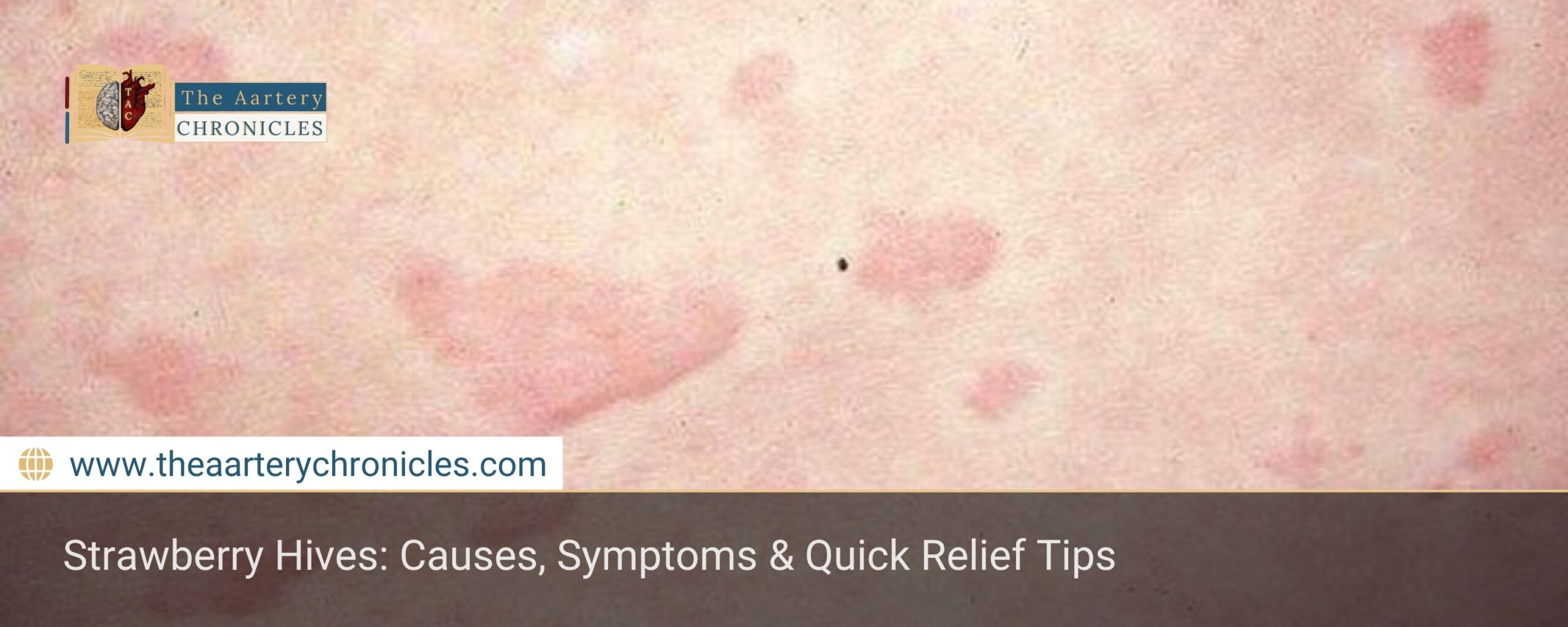 strawberry-hives-all-that-you-need-to-know-the-aartery-chronicles-tac