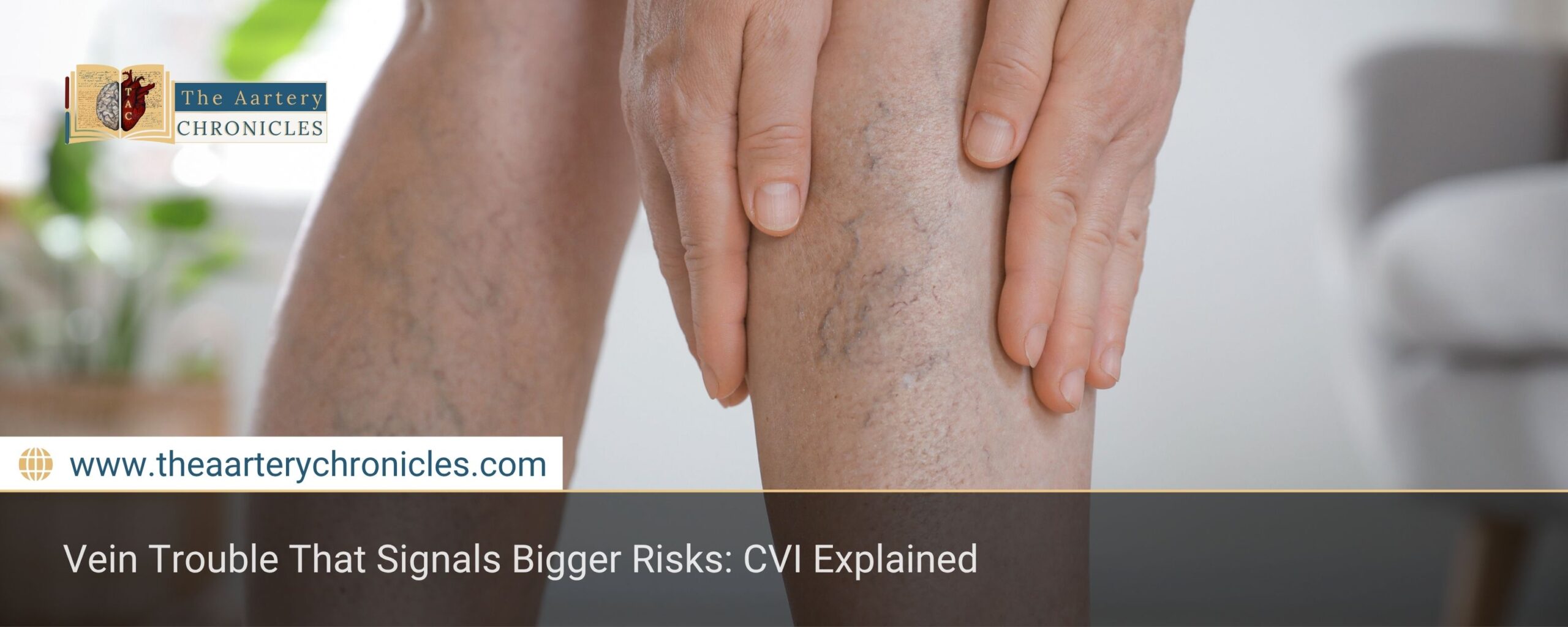 chronic-venous-insufficiency-cvi-everything-you-need-to-know-the-aartery-chronicles-tac