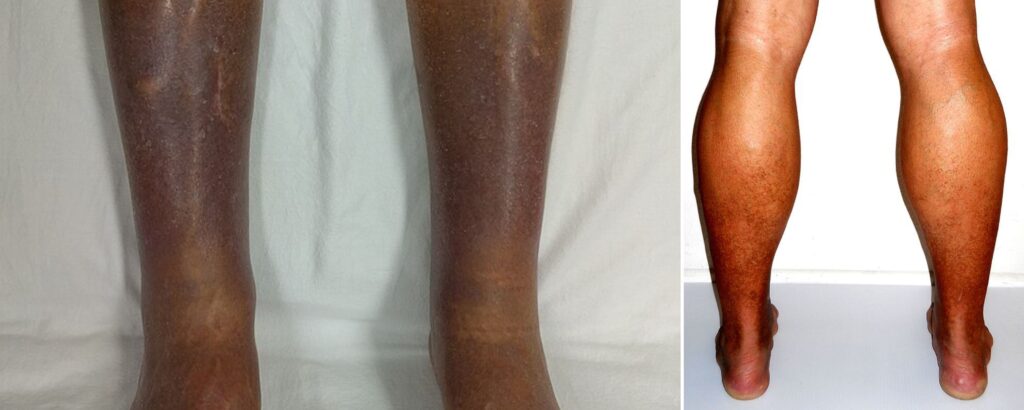 chronic-venous-insufficiency-cvi-everything-you-need-to-know-the-aartery-chronicles-tac