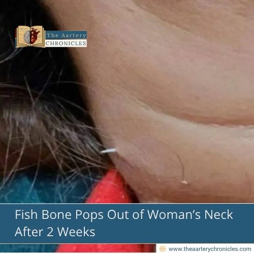Fish Bone Pops Out of Woman’s Neck After 2 Weeks