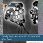 Deadly Brain Amoeba Kills 12-Year-Old After Swim