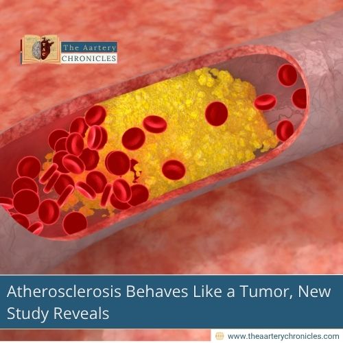 atherosclerosis-behaves-like-a-tumor-new-study-reveals-the-aartery-chronicles-tac