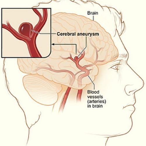 salman-khan-and-rare-brain-conditions-everything-you-need-to-know-the-aartery-chronicles-tac