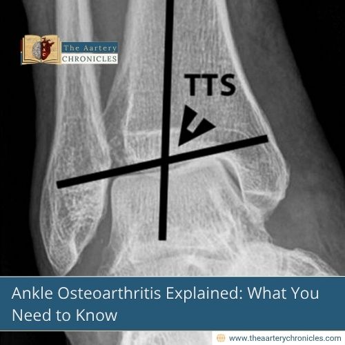 Ankle-Osteoarthritis-Explained:-What-You-Need-to-Know-The-Aartery-Chronicles-TAC