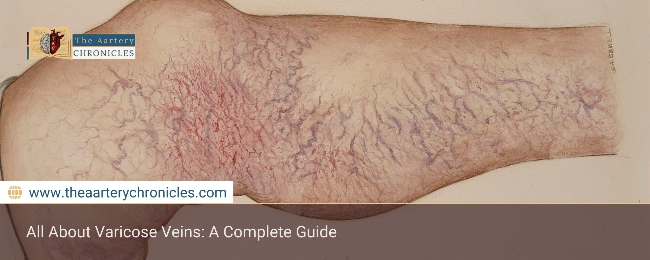 All-About-Varicose-Veins-A-Complete-Guide-The-Aartery-Chronicls-TAC