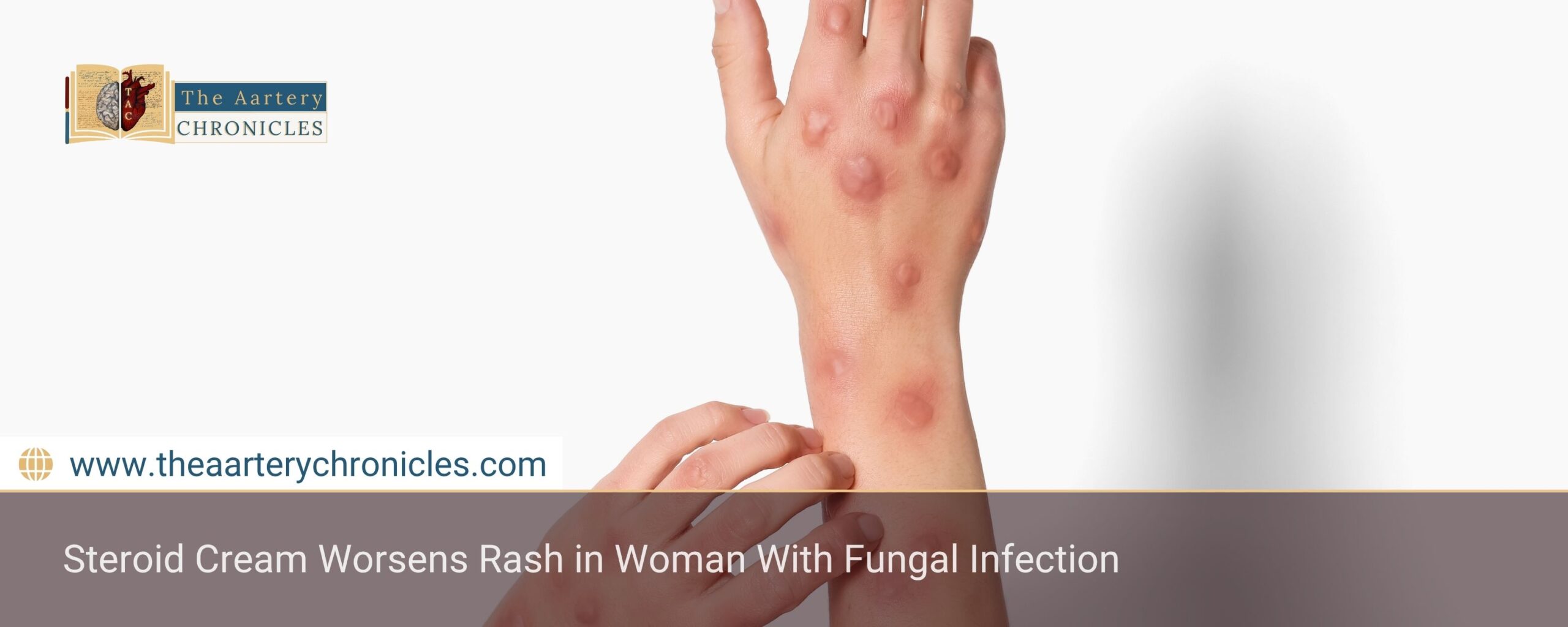 steroid-cream-worsens-rash-in-woman-with-fungal-infection-the-aartery-chronicles-tac