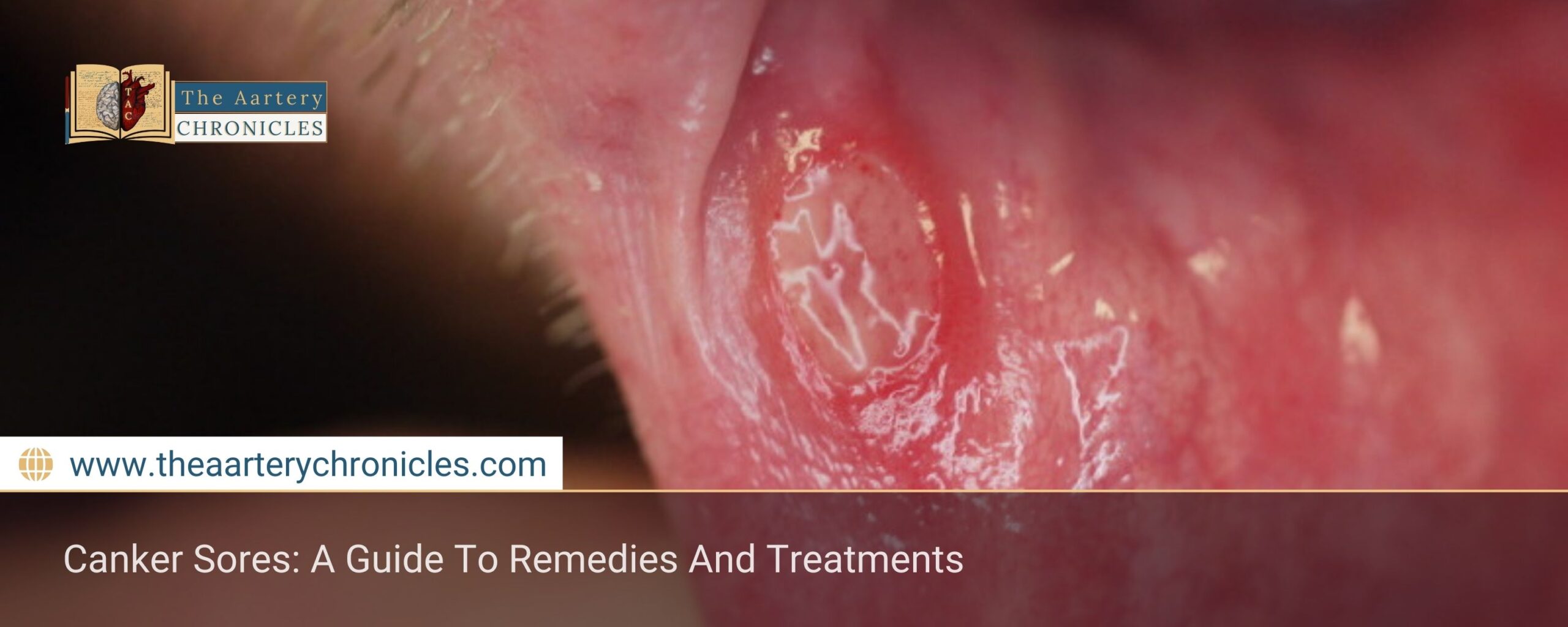 Canker-Sores:-A-Guide-To-Remedies-And-Treatments-The-Aartery-Chronicles-TAC