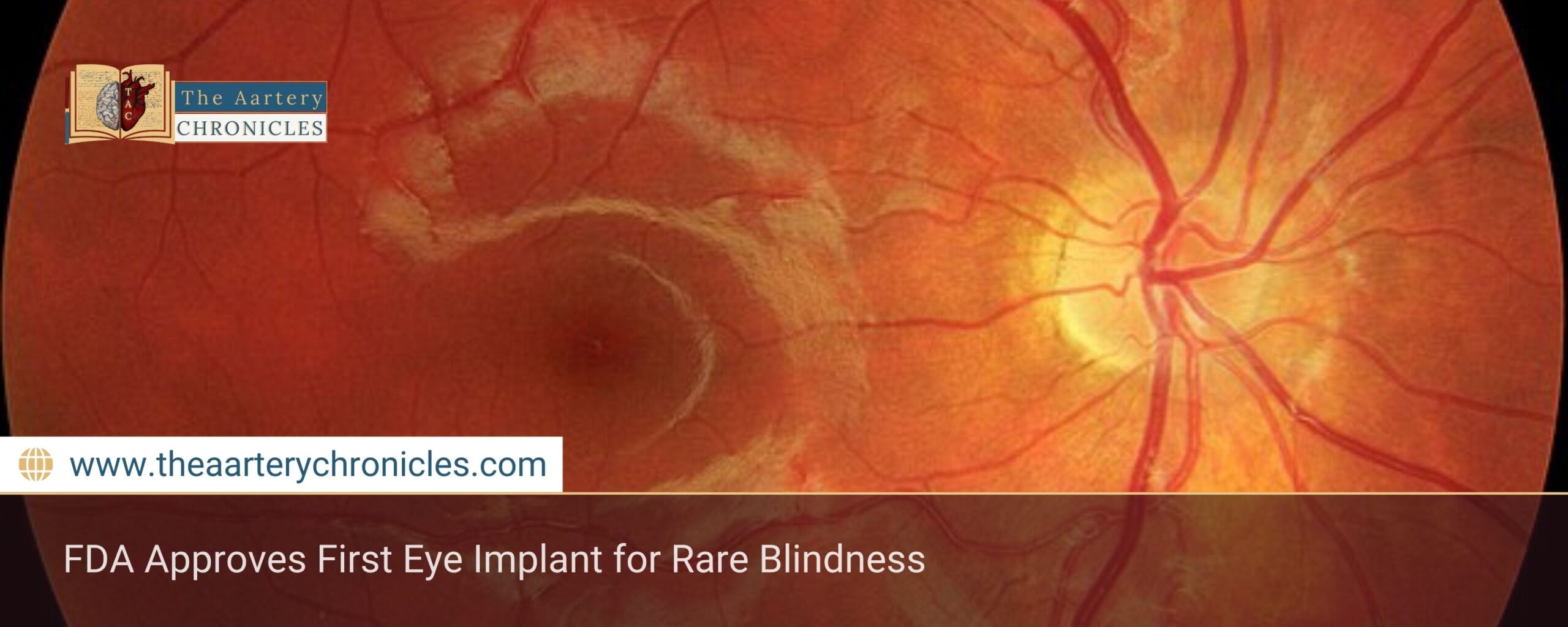 fda-approves-first-eye-implant-for-rare-blindness-the-aartery-chronicles-tac