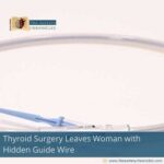 Thyroid Surgery Leaves Woman with Hidden Guide Wire