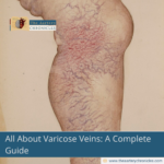 All-About-Varicose-Veins-A-Complete-Guide-The-Aartery-Chronicls-TAC