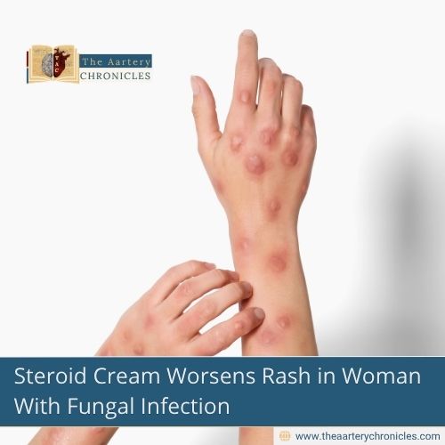 Steroid Cream Worsens Rash in Woman With Fungal Infection
