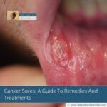 Canker-Sores:-A-Guide-To-Remedies-And-Treatments-The-Aartery-Chronicles-TAC