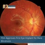 fda-approves-first-eye-implant-for-rare-blindness-the-aartery-chronicles-tac