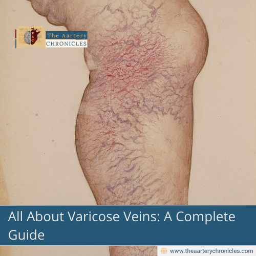 All-About-Varicose-Veins-A-Complete-Guide-The-Aartery-Chronicls-TAC