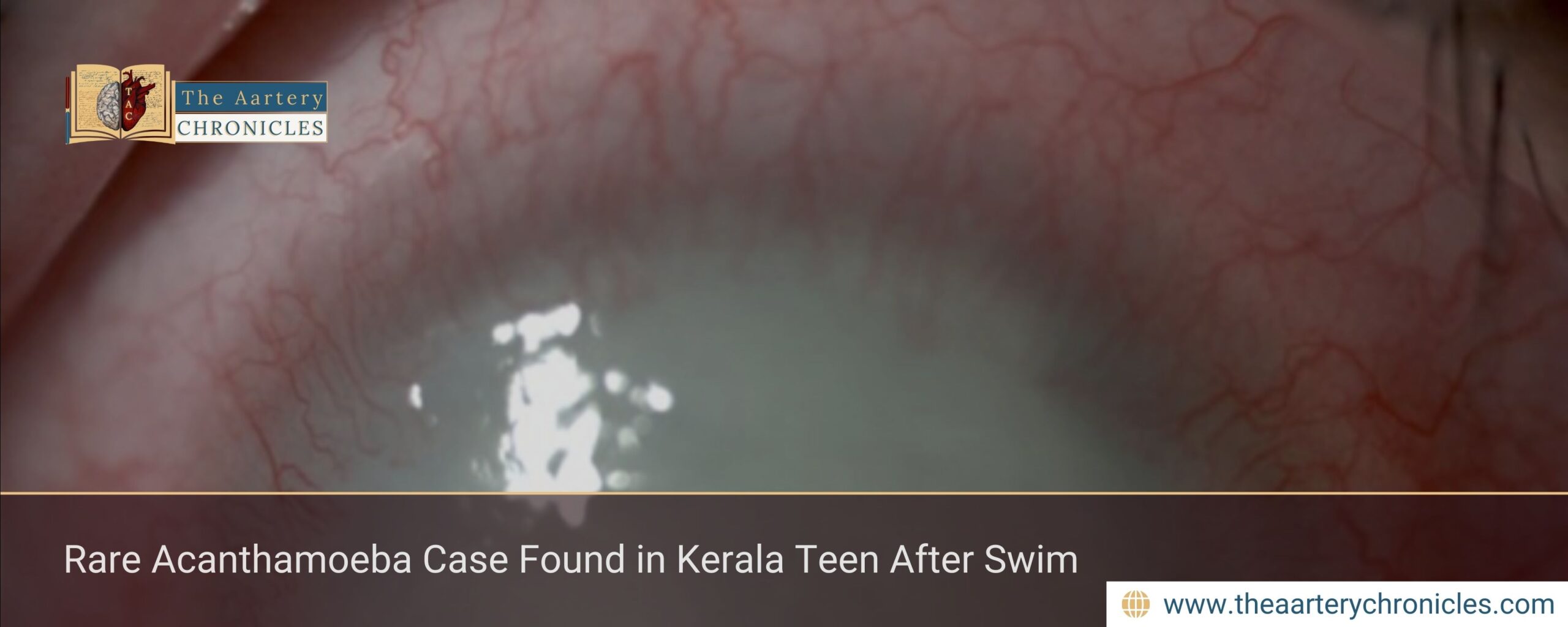 Rare Acanthamoeba Case Found in Kerala Teen After Swim