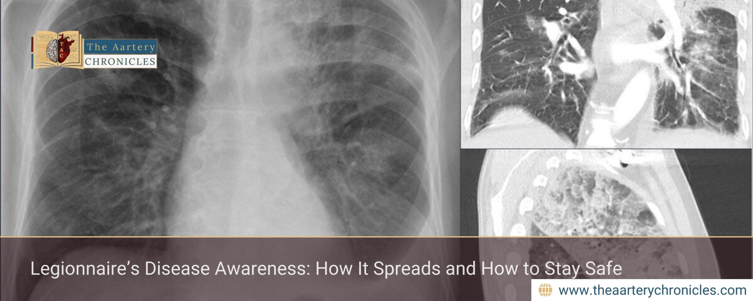 Legionnaire’s-Disease-Awareness:-How-It-Spreads-and-How-to-Stay-Safe-The-Aartery-Chronicles-TAC