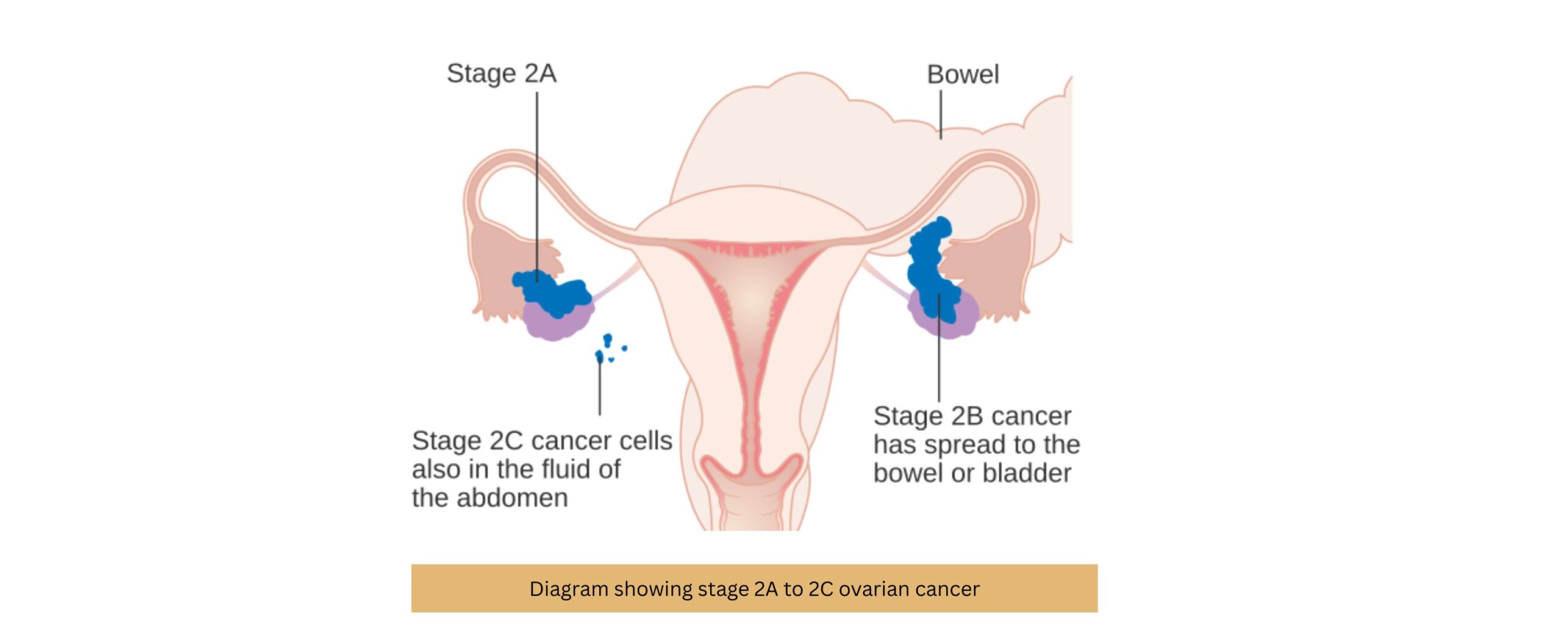 Ovarian-Cancer-Awareness-Month:-Why-Awareness-Matters?-The-Aartery-Chronicles-TAC