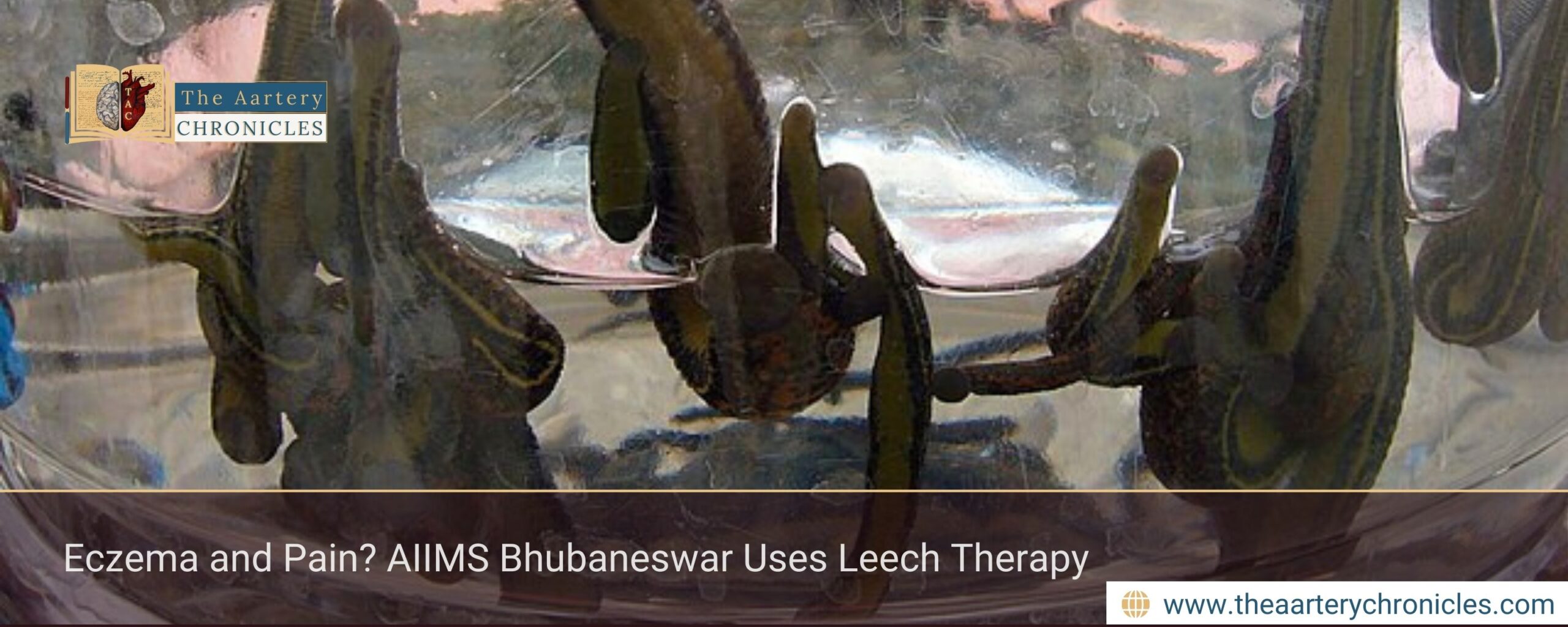 Eczema and Pain? AIIMS Bhubaneswar Uses Leech Therapy