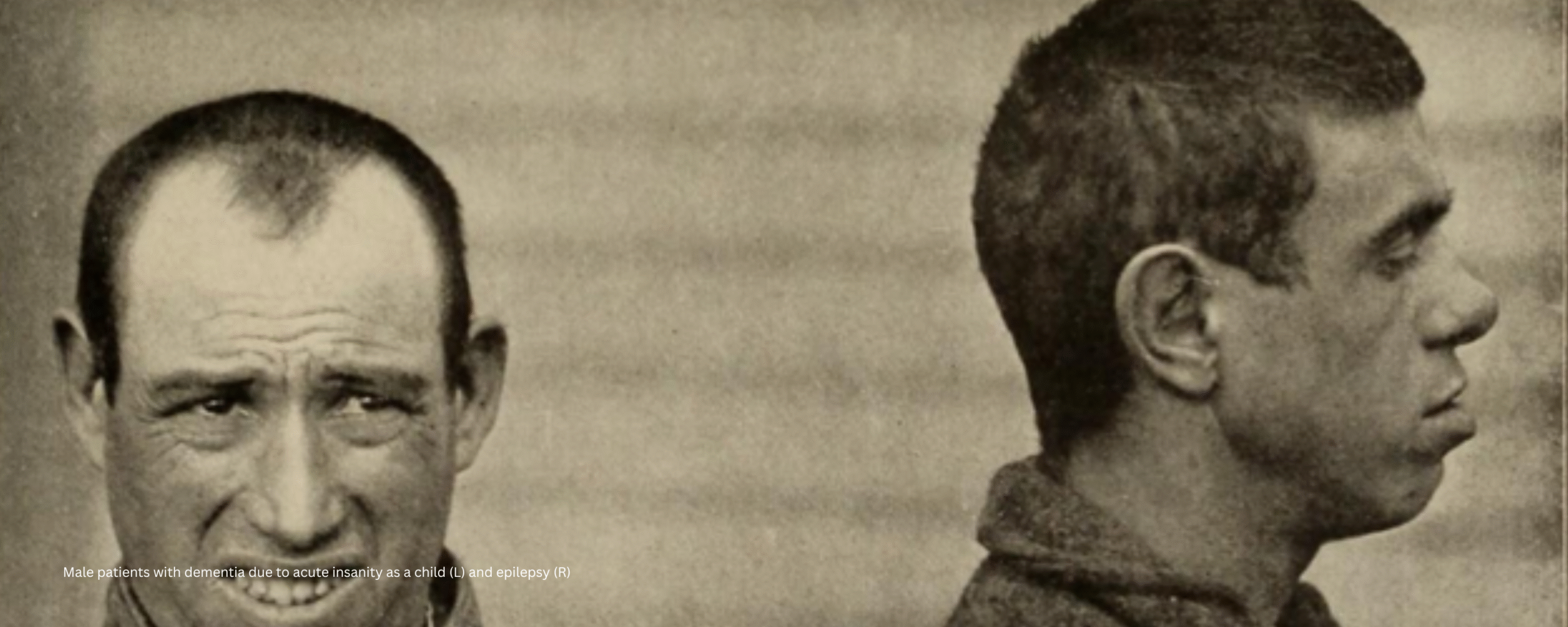 Male patients with dementia due to acute insanity as a child (L) and epilepsy (R)