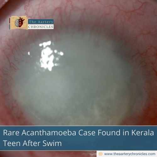 Rare Acanthamoeba Case Found in Kerala Teen After Swim