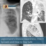 Legionnaire’s-Disease-Awareness:-How-It-Spreads-and-How-to-Stay-Safe-The-Aartery-Chronicles-TAC