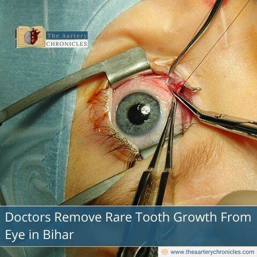 Doctors Remove Rare Tooth Growth From Eye in Bihar