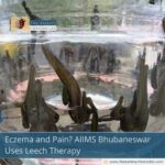 Eczema and Pain? AIIMS Bhubaneswar Uses Leech Therapy