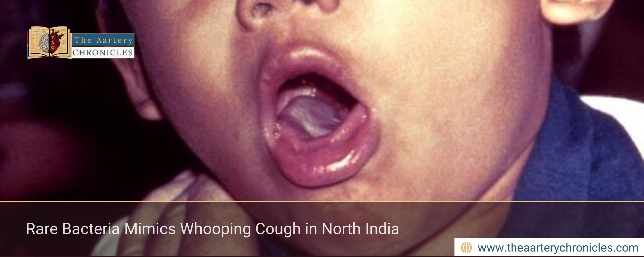 Rare Bacteria Mimics Whooping Cough in North India