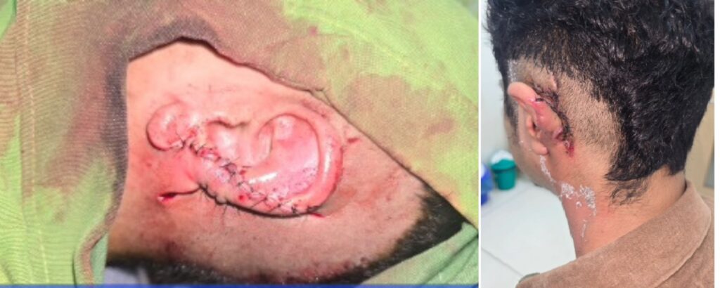 remarkable-recovery-after-ear-mutilation-by-human-bite-the-Aartery-Chronicles-TAC