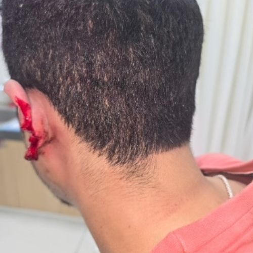 remarkable-recovery-after-ear-mutilation-by-human-bite-the-Aartery-Chronicles-TAC