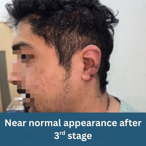 remarkable-recovery-after-ear-mutilation-by-human-bite-the-Aartery-Chronicles-TAC