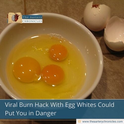 Viral Burn Hack With Egg Whites Could Put You in Danger