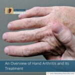 hand osteoarthritis, osteoarthritis, hand arthritis, arthritis, osteoarthritis in the hands, degenerative disease, joint pain, stiffness, swelling, inflammation, cartilage, joints, interphalangeal joints, trapezium-metacarpal joint, thumb base joint, Heberden’s nodes, Bouchard’s nodes, reduced grip strength, difficulty moving, diagnosis of hand osteoarthritis, X-rays, bone spurs, osteophytes, treatments for hand osteoarthritis, hand arthritis treatment, pain relief, nonsteroidal anti-inflammatory drugs, corticosteroid injections, physiotherapy, physical therapy, occupational therapy, hand exercises, natural remedies, alternative treatments, hot or cold compresses, supplements, joint health, arthroplasty, arthrodesis, surgery, prevention of hand osteoarthritis, ergonomic tools