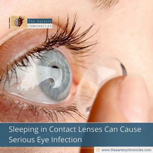 Sleeping in Contact Lenses Can Cause Serious Eye Infection
