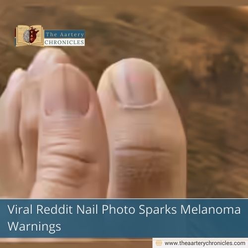 Viral Reddit Nail Photo Sparks Melanoma Warnings
