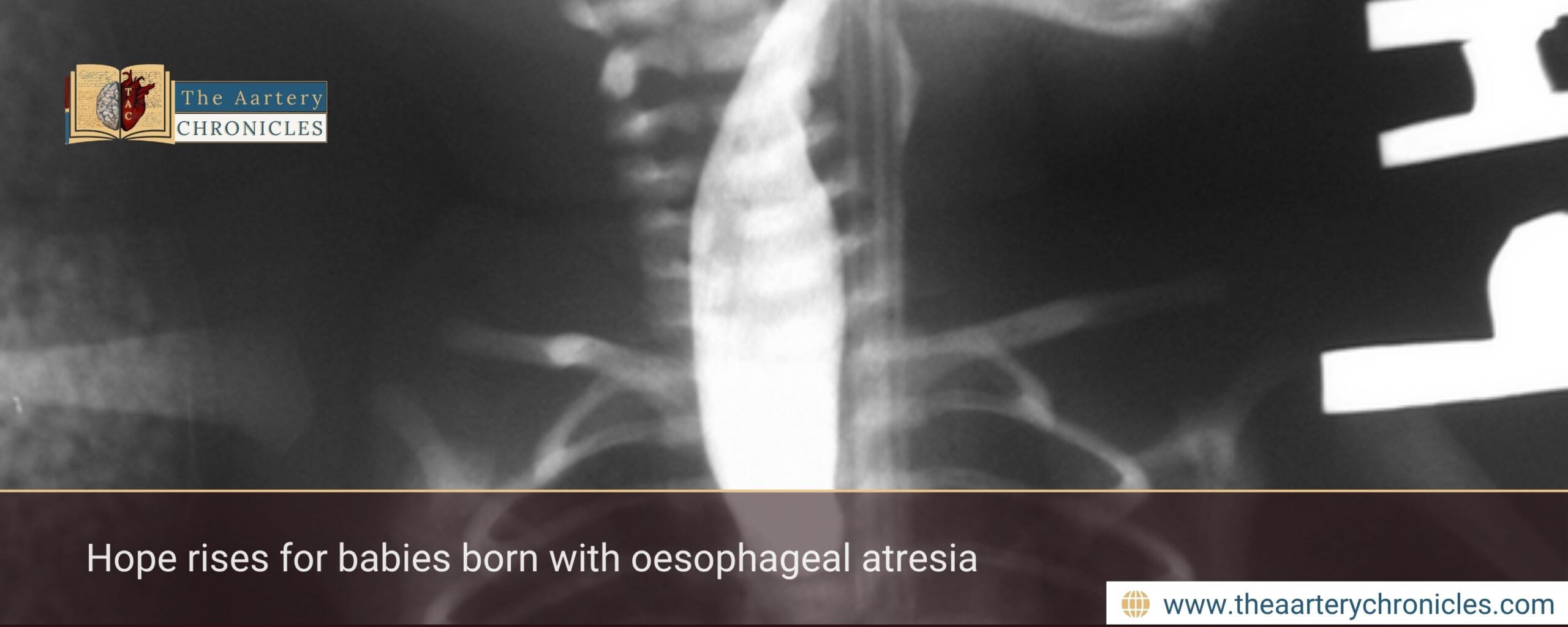 Hope rises for babies born with oesophageal atresia