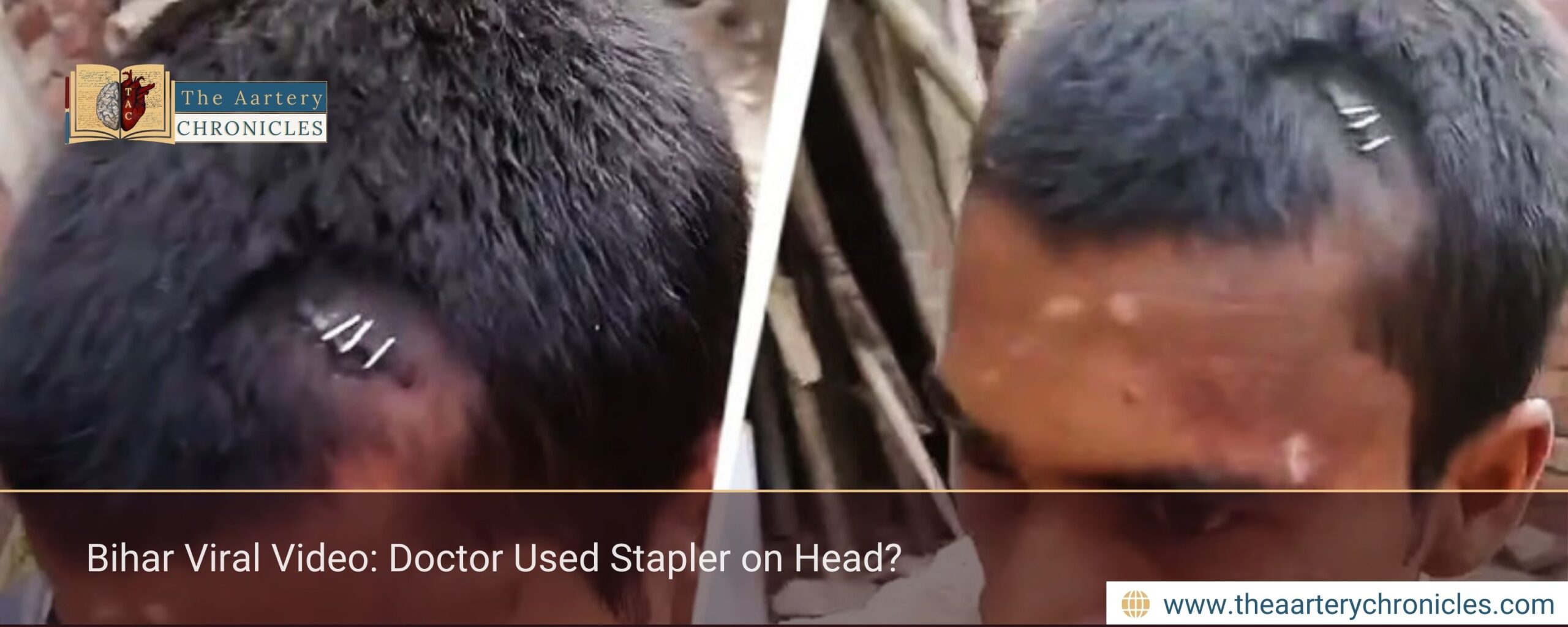Bihar Viral Video: Doctor Used Stapler on Head?