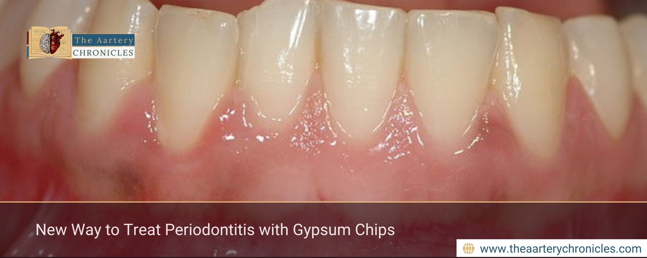 New Way to Treat Periodontitis with Gypsum Chips