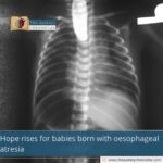 Hope rises for babies born with oesophageal atresia