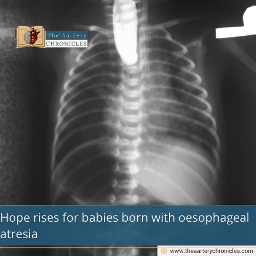 Hope rises for babies born with oesophageal atresia