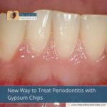 New Way to Treat Periodontitis with Gypsum Chips