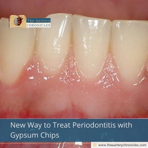 New Way to Treat Periodontitis with Gypsum Chips
